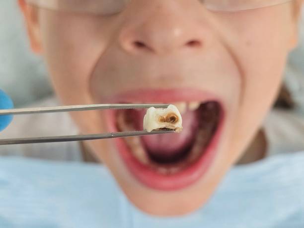 Best Broken or Cracked Tooth Emergency Dentist in Lincoln Village, OH